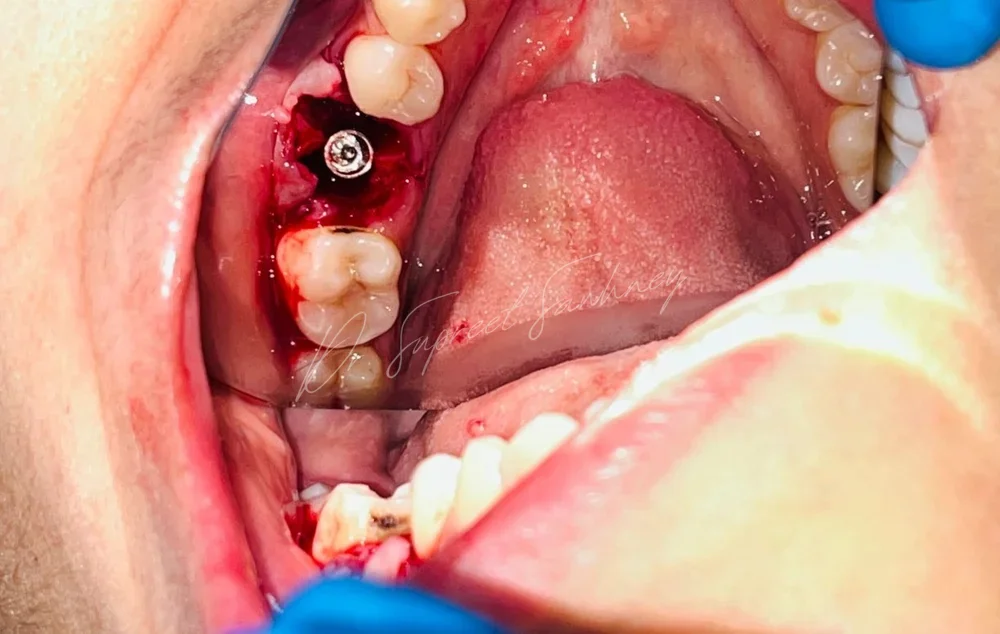 Intraoperative occlusal view showing an implant fixture placed in a posterior mandibular site